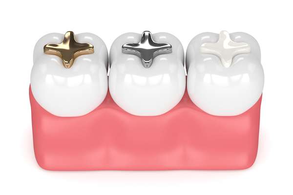 Dental Crowns - Bison Dentistry